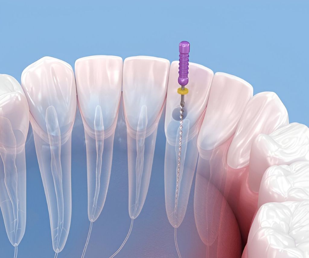 root canal therapy in jacksonville fl